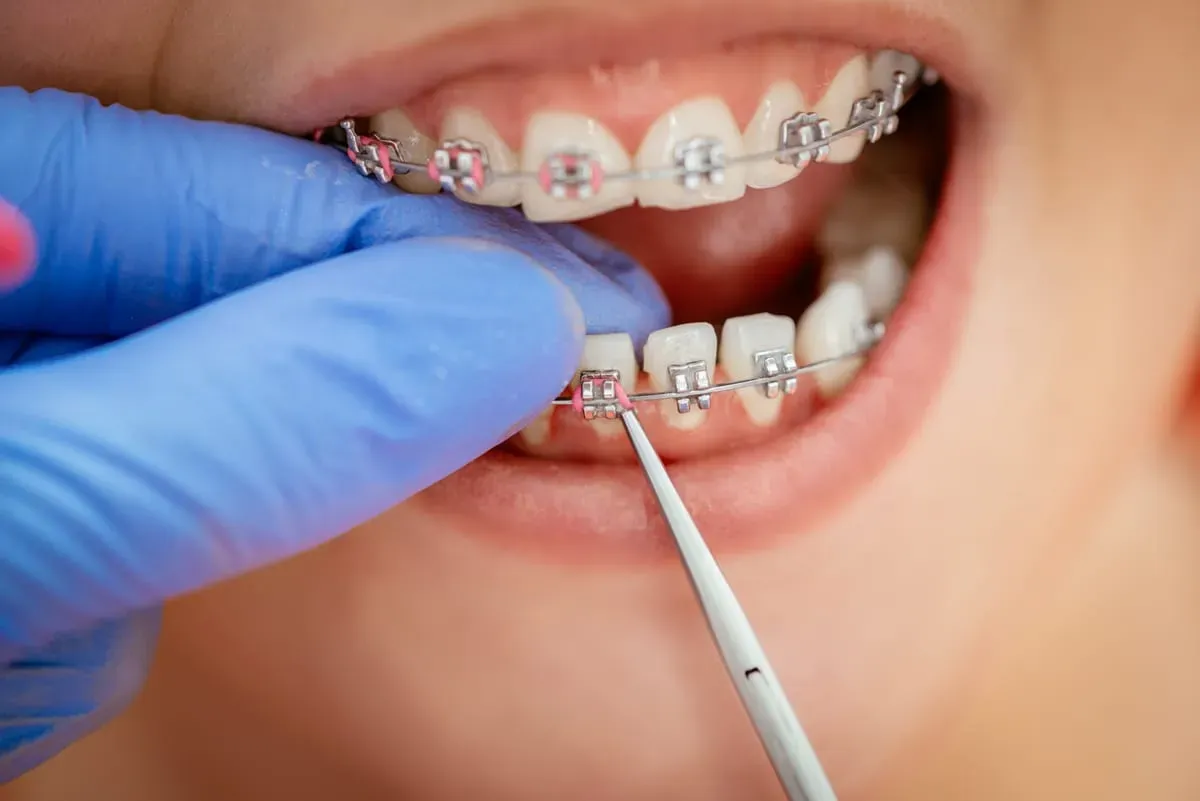Tooth Fillings: What to Expect, Materials & Aftercare
