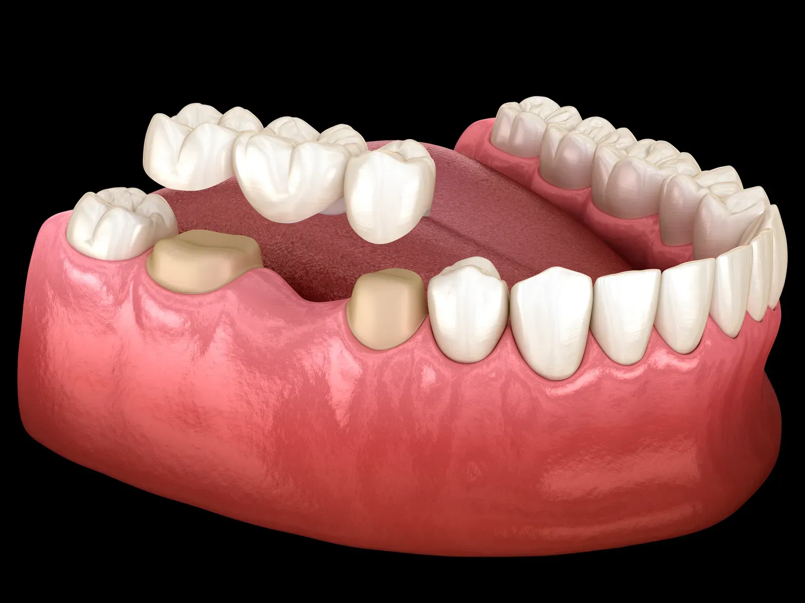 Dental Bridges at In Smyle Dental