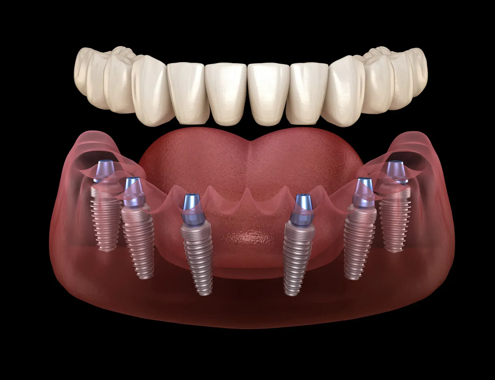Dental Implants at In Smyle Dental